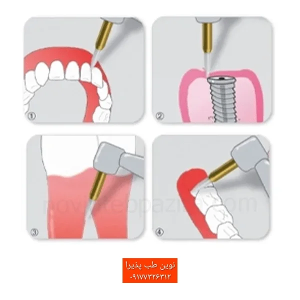فرز سرامیکی جهت برش وجراحی لثه (بدون خونریزی)- TissuecTrimmer — تصویر ۲