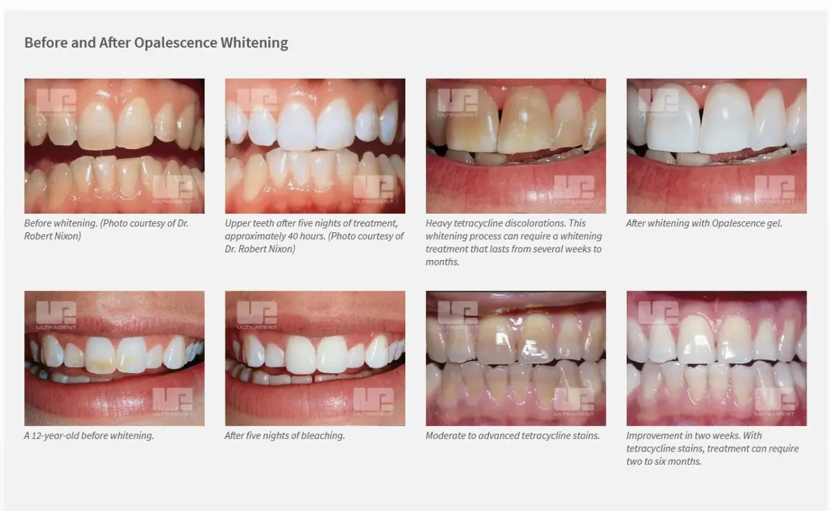بلیچینگ هوم اپال سنس الترادنت - Ultradent Opalescence PF — تصویر ۲