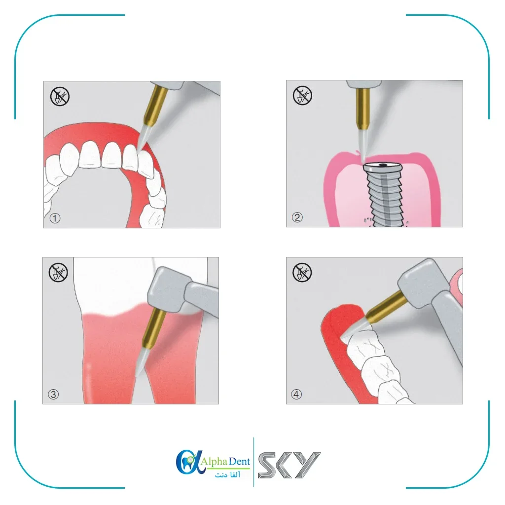 فرز سرامیکی CTT (CERAMIC TISSUE TRIMMER) — تصویر ۴