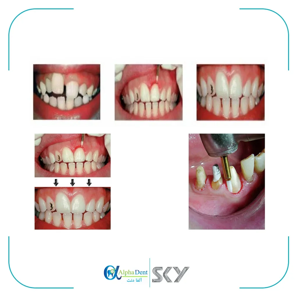 فرز سرامیکی CTT (CERAMIC TISSUE TRIMMER) — تصویر ۵