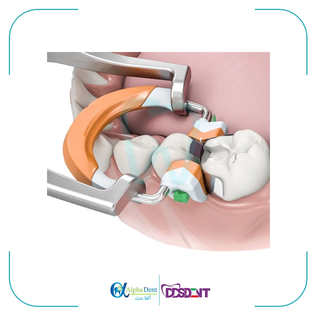 کلمپ سکشنال گریسون (G-CLAMP) — تصویر ۲